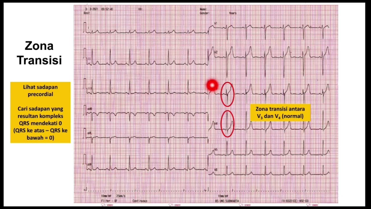 Step by step Interpretasi Elektrokardiografi EKG bersama dr. Risalina Myrtha, SpJP, FIHA