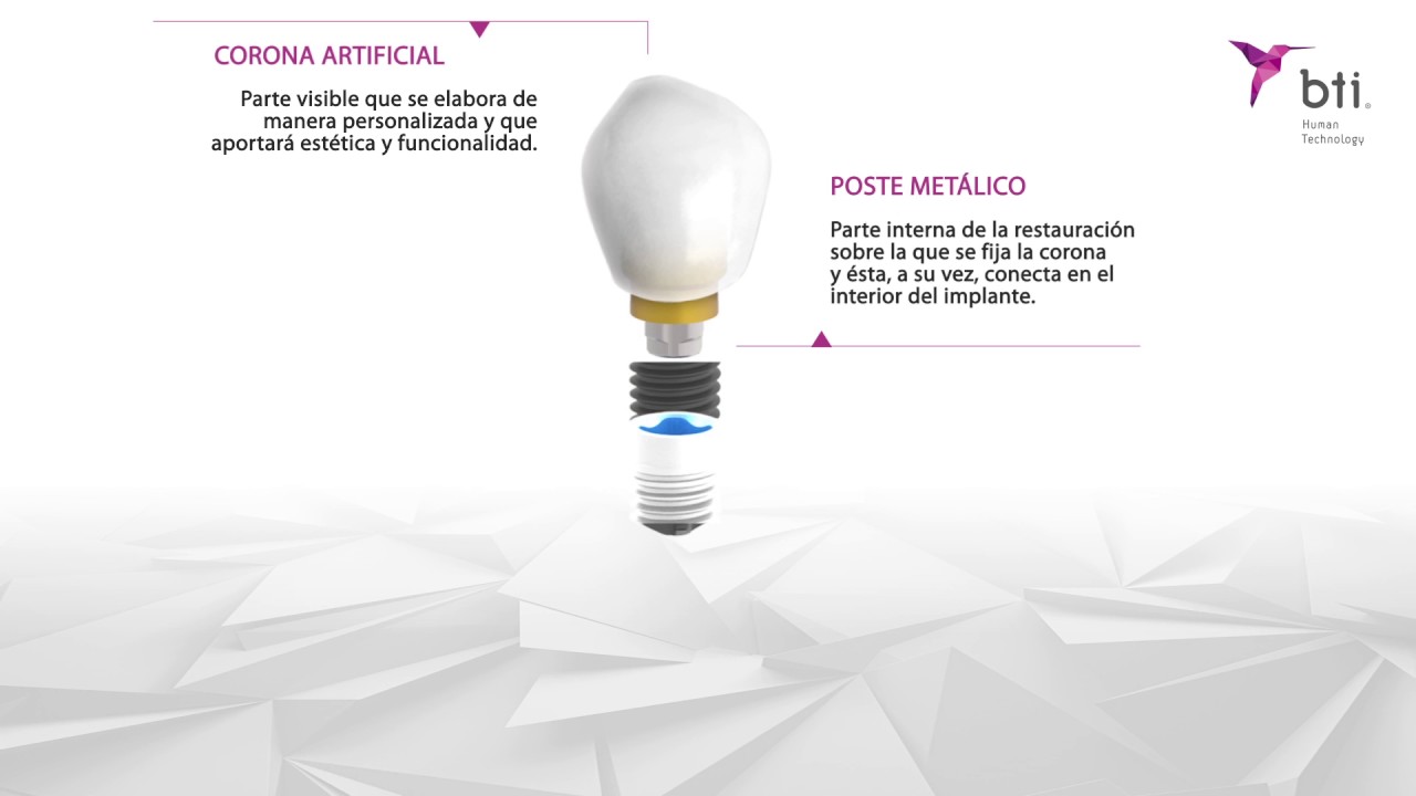 ¿Qué son los implantes dentales?