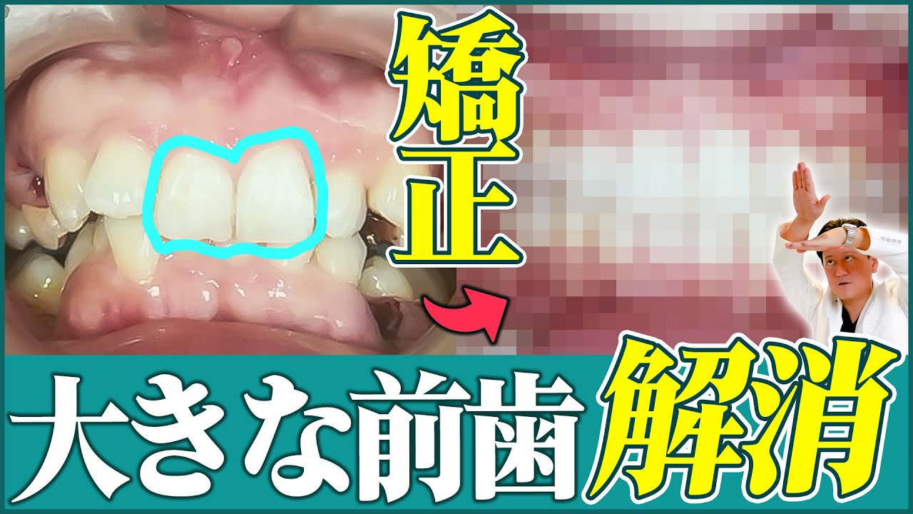 ディープバイトの矯正！大きく見える前歯は矯正治療で改善できますか？【審美歯科 歯列矯正 歯並び 出っ歯】