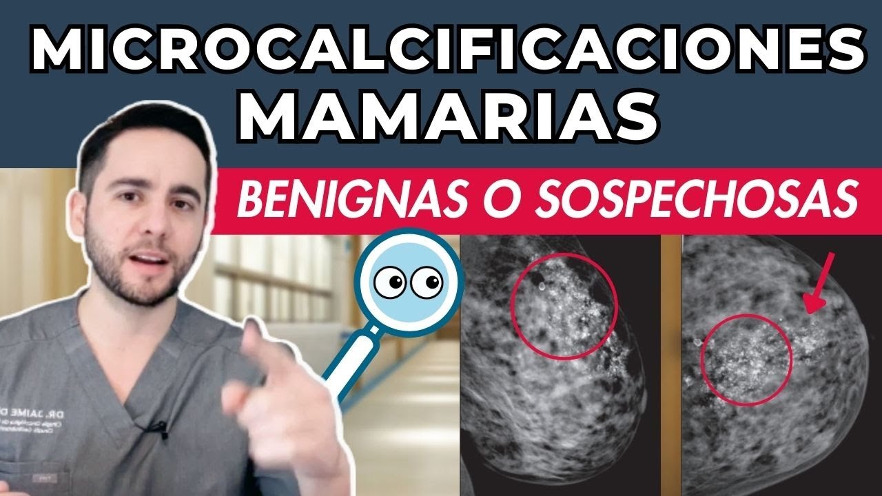 MICROCALCIFICACIONES MAMARIAS - Sospechosas o Benignas