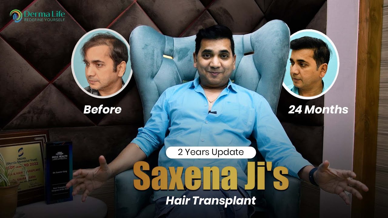24 Months Celebrity Hair Transplant Results | Hair Transplant Cost in Mumbai Best Doctors