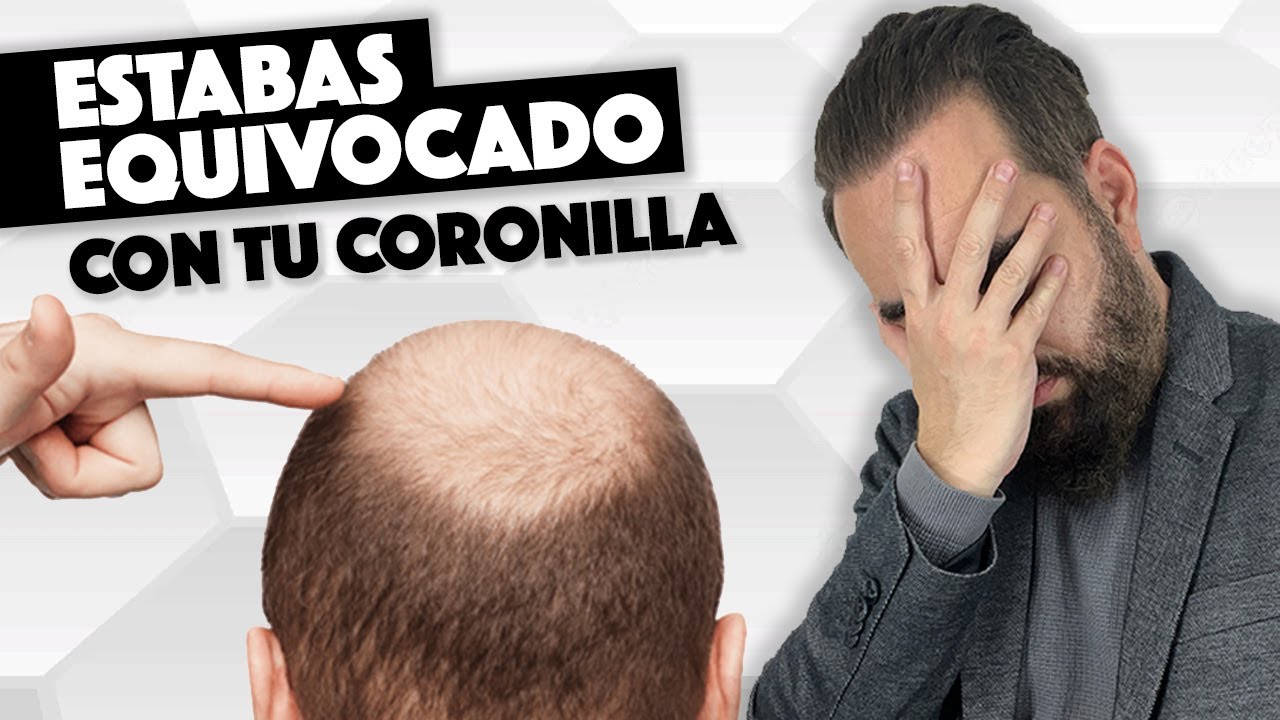 Estabas equivocado sobre la Evolución de la coronilla de tu  trasplante capilar