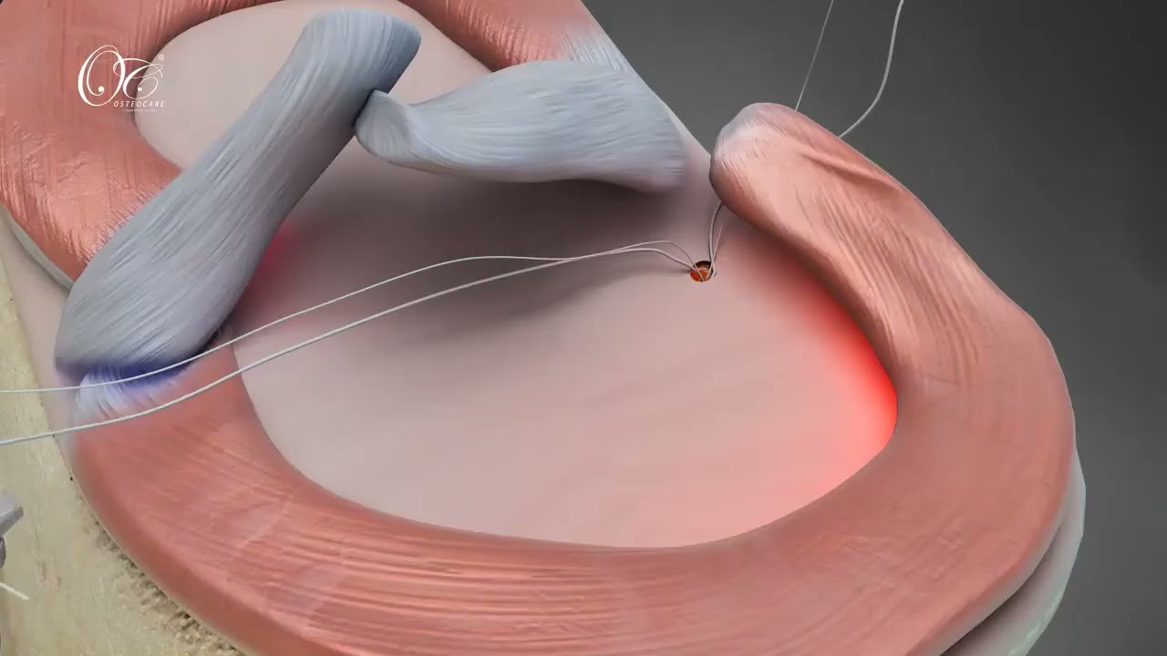 OC RootFix Anchor For Meniscus Root Repair | Animation