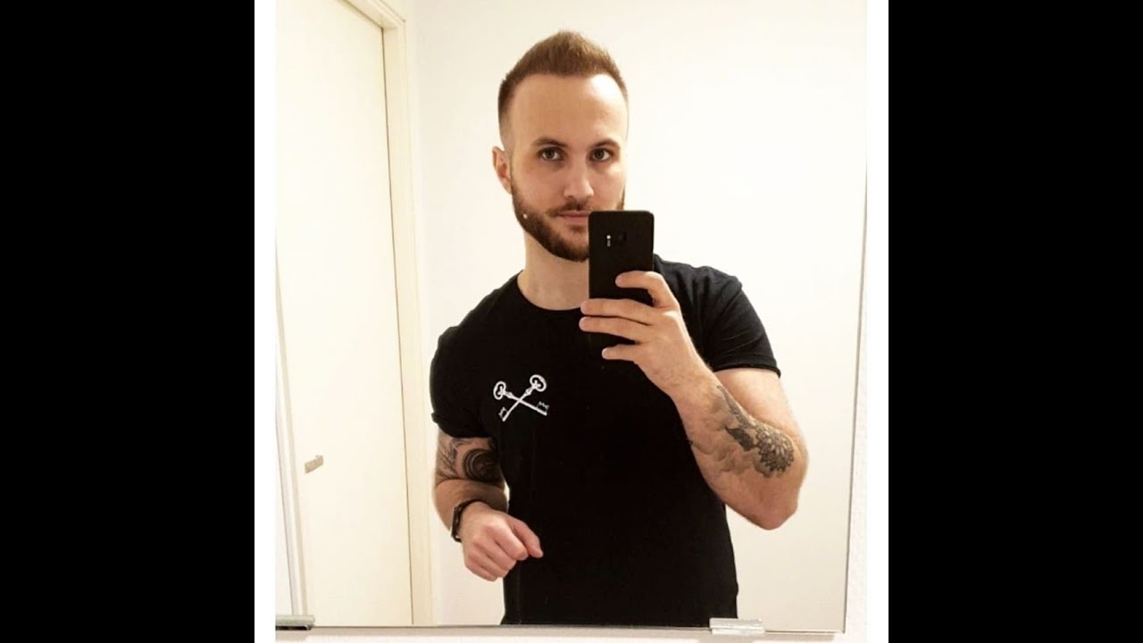 6 månaders resultat efter hårtransplantation.