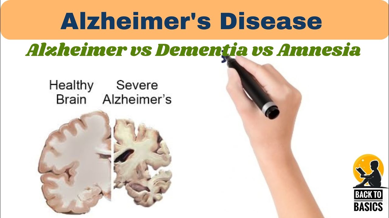 Alzheimer's Disease, difference between Alzheimer, dementia and amnesia