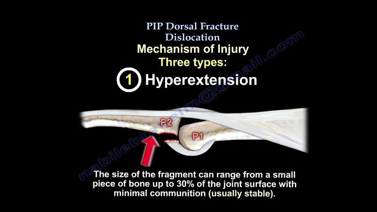 PIP Dorsal Fracture Dislocation - Everything You Need To Know - Dr. Nabil Ebraheim