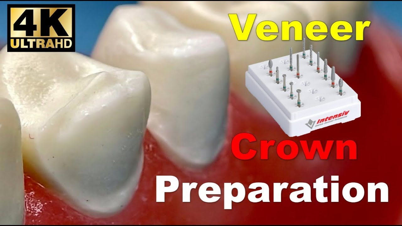 Veneer and Crown Prep Step-by-Step