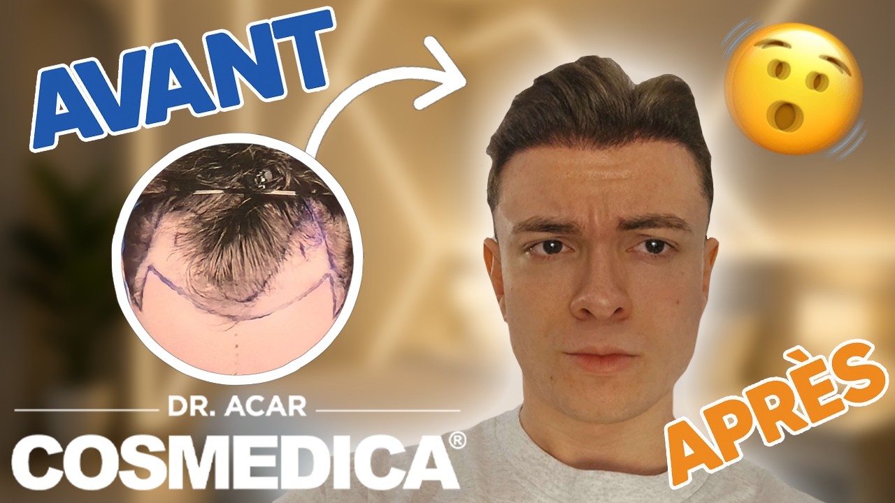 COSMEDICA Dr. Acar – Greffe de cheveux Turquie | Mois 5 : Densité incroyable