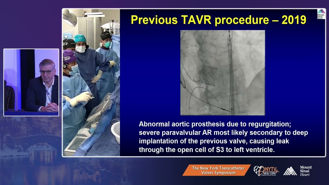 LIVE CASE 1- VALVE-IN-VALVE