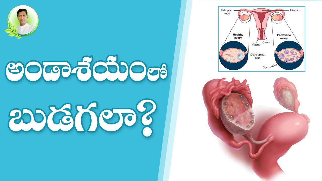 Home Remedies For Ovarian Cyst | Health Tips In Telugu | Manthena Satyanarayana Raju Videos