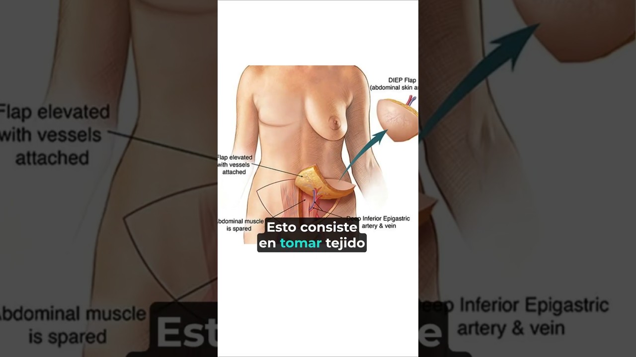 Cierre est&eacute;tico plano despu&eacute;s de la mastectom&iacute;a