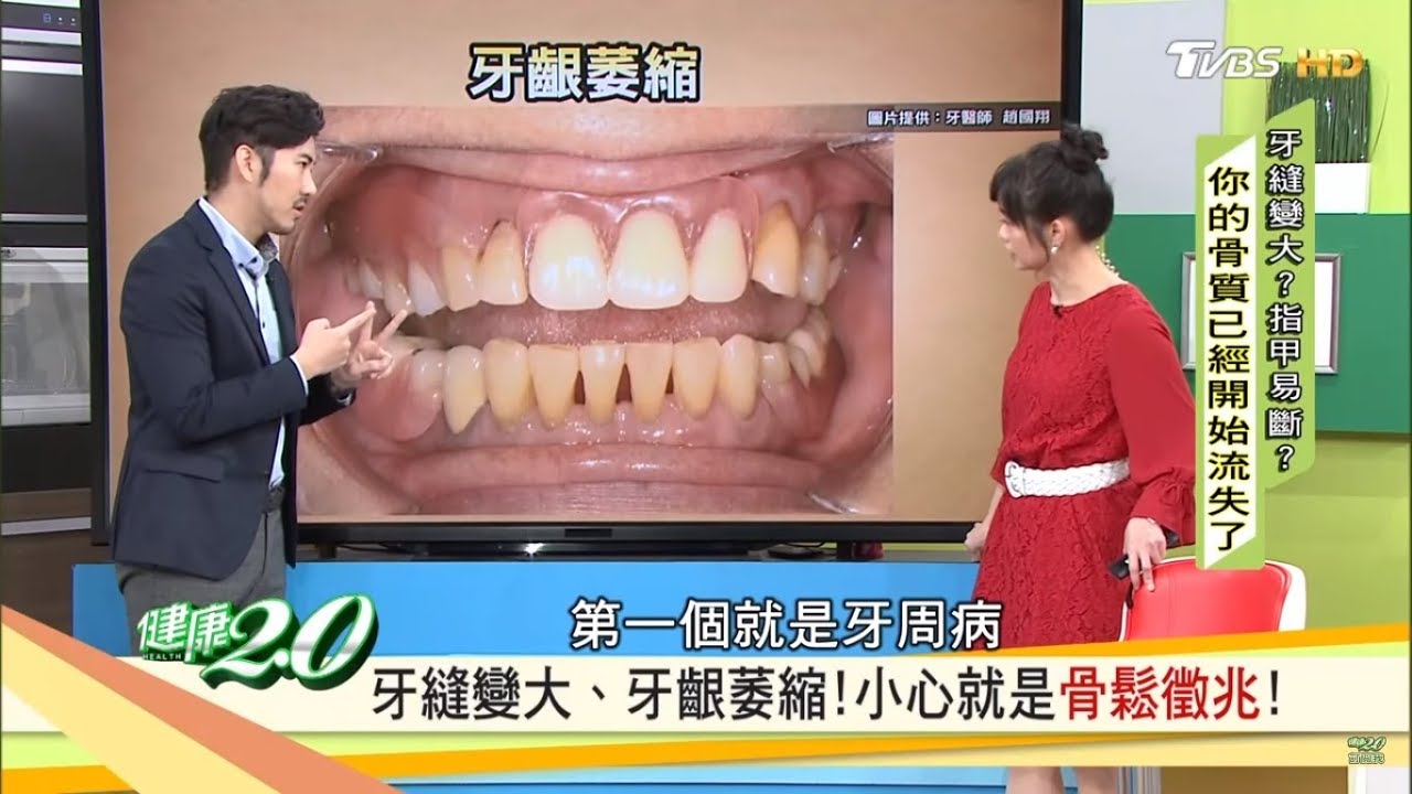 別輕忽骨質疏鬆！牙縫變大、牙齦萎縮，小心就是「骨鬆」徵兆！健康2.0