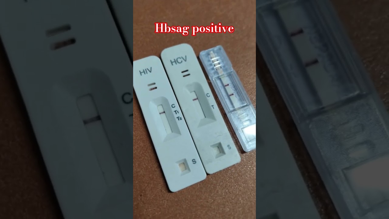 Hbsag test positive #💉🧪🔬👍