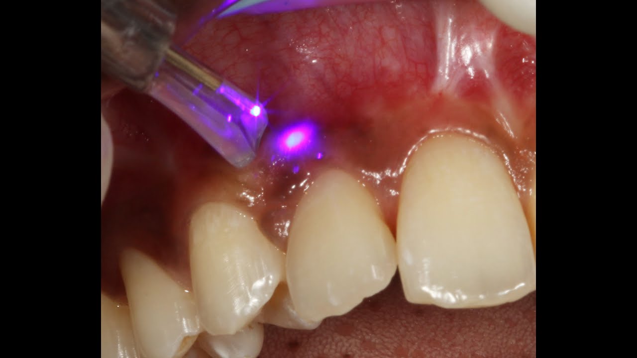 Gingival Depigmentation, Ablative vs Non ablative Laser