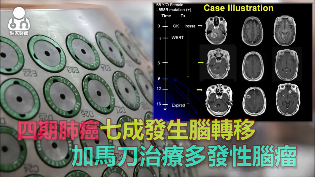 台中榮總-四期肺癌病人，七成發生腦轉移腫瘤！
