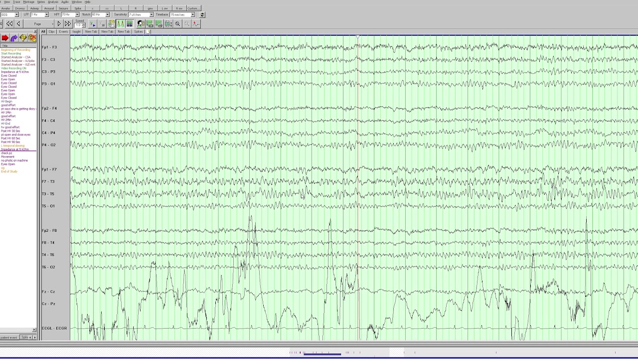 More Focal Slowing