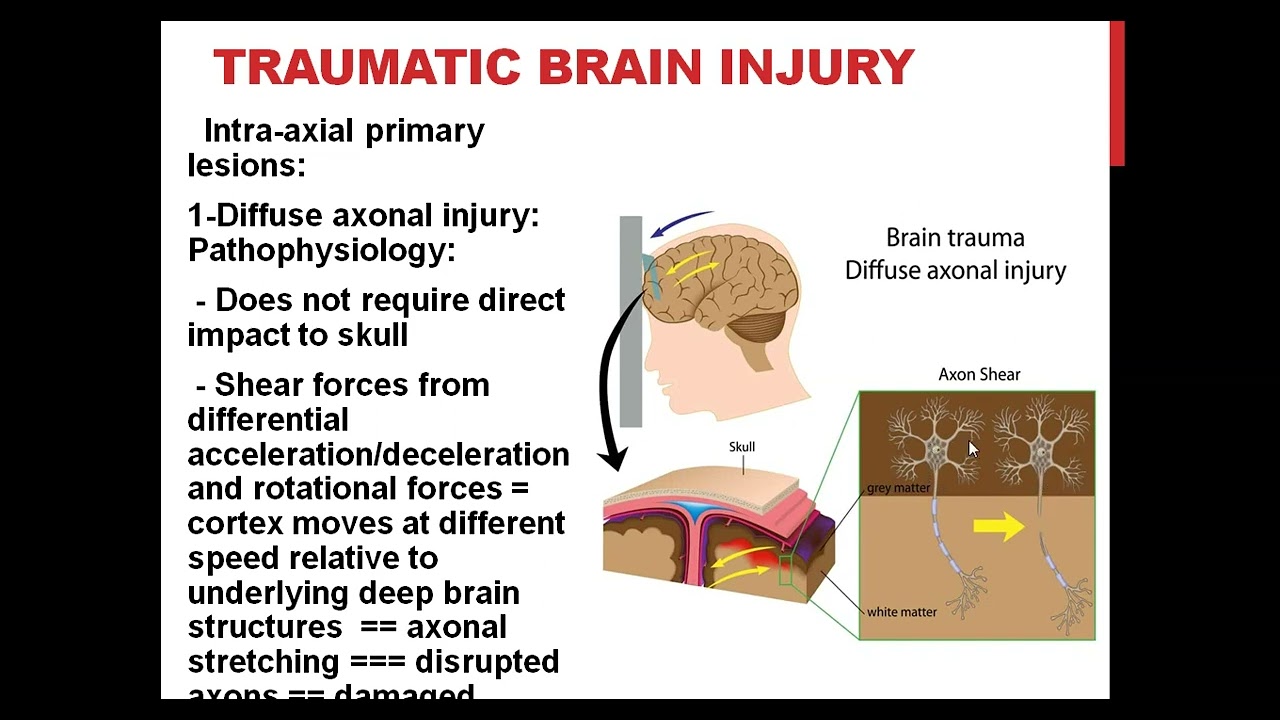 Traumatic Brain Injury Prof hesham elshaikh