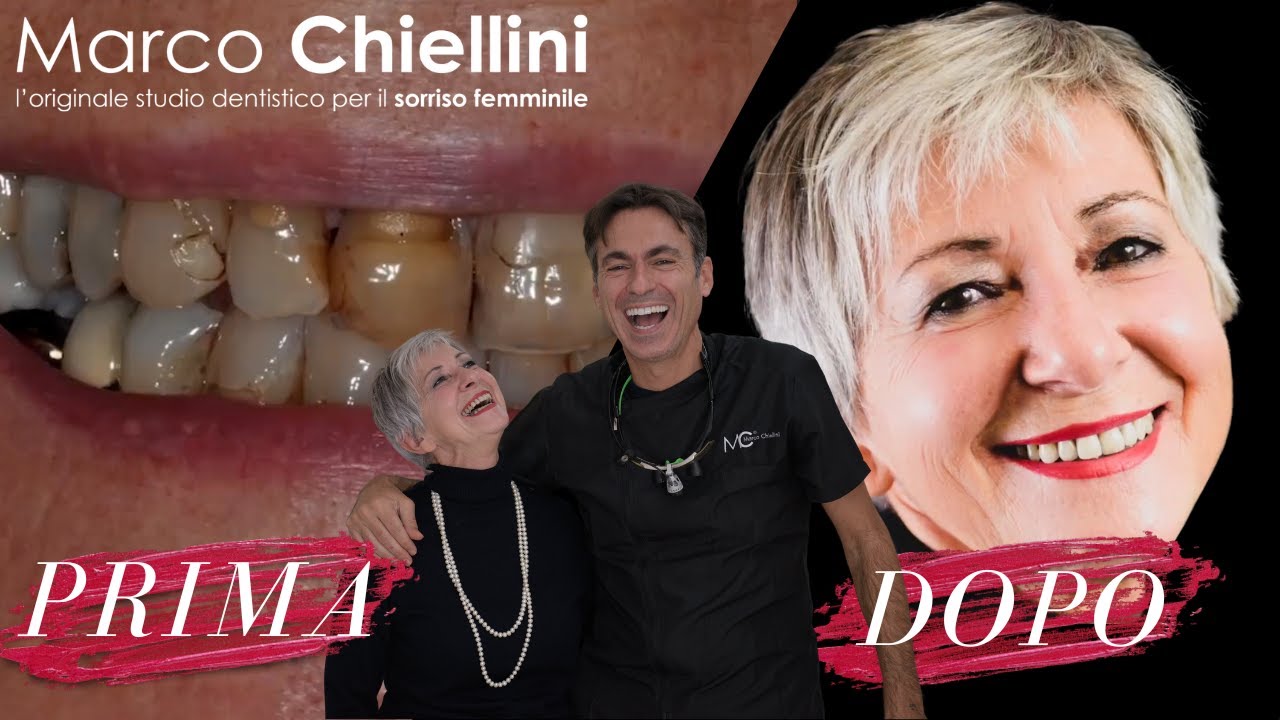 Quanto costa fare le FACCETTE DENTALI per un sorriso perfetto?