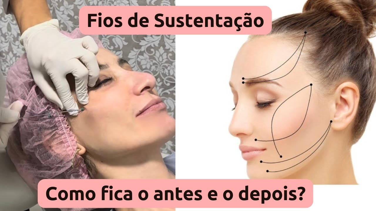 Como fica o antes e o depois dos fios de sustentação?