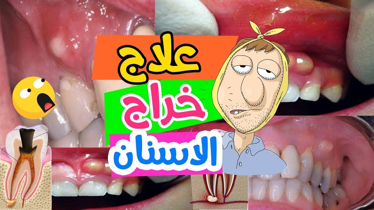 علاج خراج الاسنان || خراج الاسنان || حشو العصب