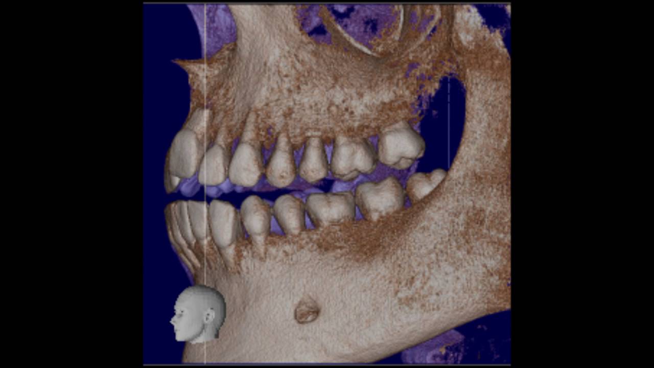 Morita 3D CBCT ki&eacute;rt&eacute;kel&eacute;se, OneVolumeViewer program oktat&oacute;vide&oacute;