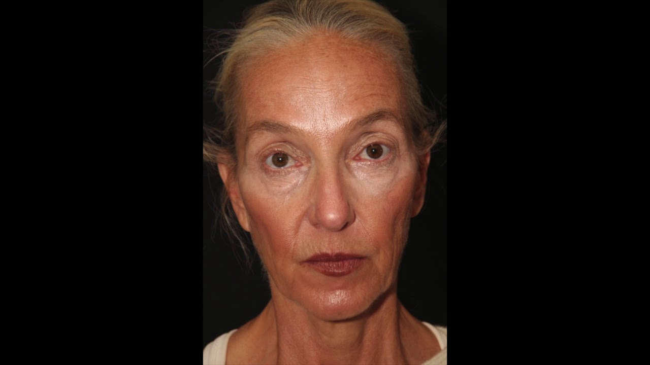 Earlobe Reduction Surgery Results | Bilateral Earlobe Surgery Toronto by Dr. Philip Solomon
