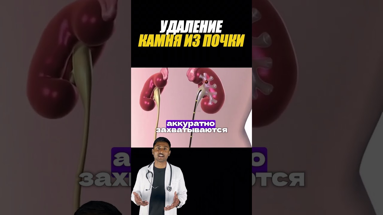 Удаление камней в почках лазером #почки #операция #shorts