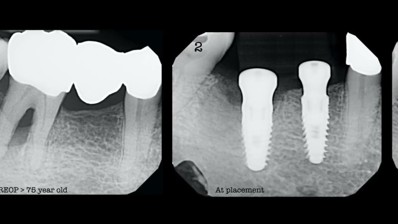 BONE REGENERATION for dental implants