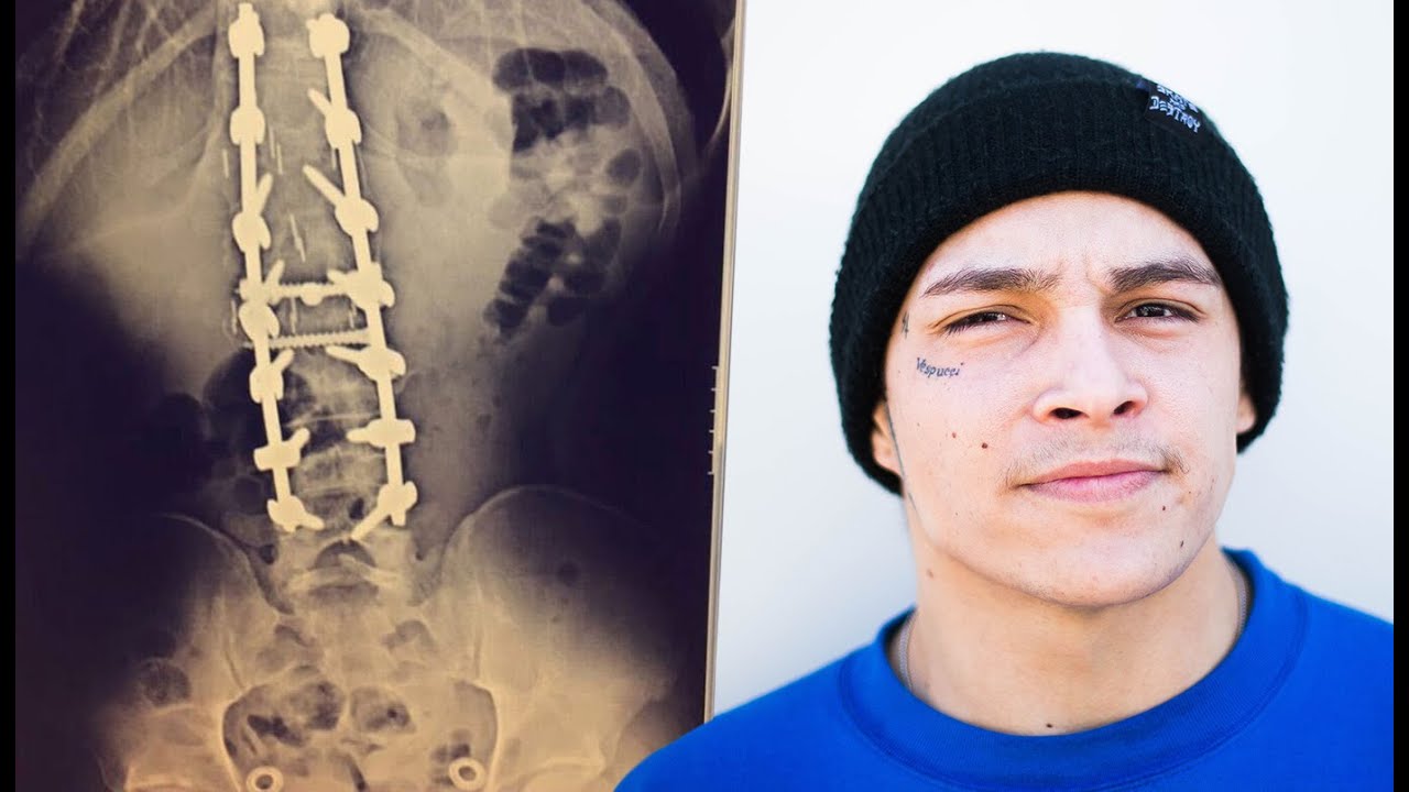 Damon Beierlorzer's Injury Story