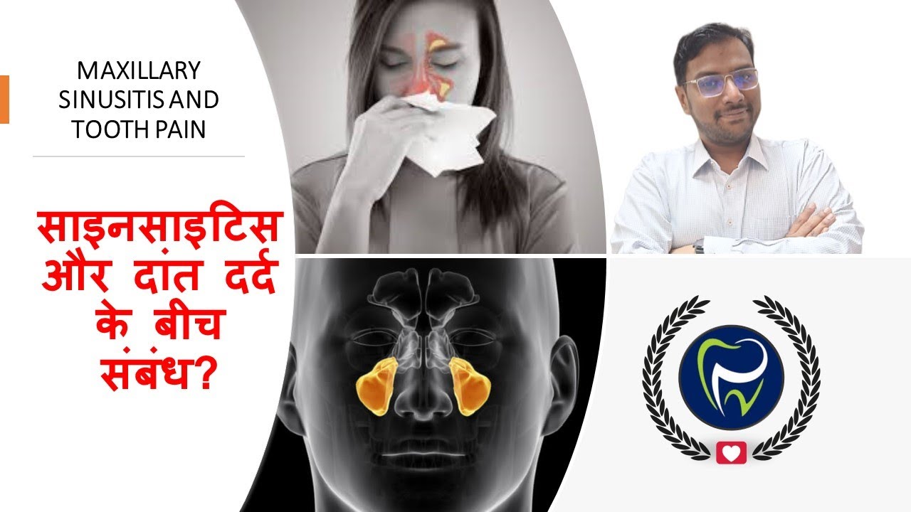 Dr Rudra Mohan |साइनसाइटिस और दांत दर्द के बीच संबंध?|LINK BETWEEN MAXILLARY SINUSITIS & TOOTH PAIN
