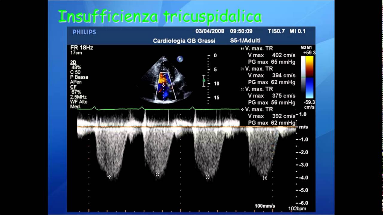 Elementi di ecocardiografia: IX video, valvulopatia tricuspidalica.