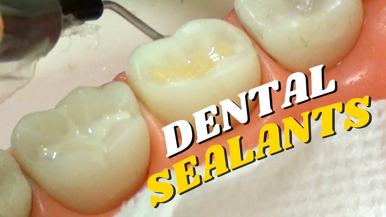 How to Apply Dental Sealants: Step by Step Procedure | In Office to Hands On Dental Training