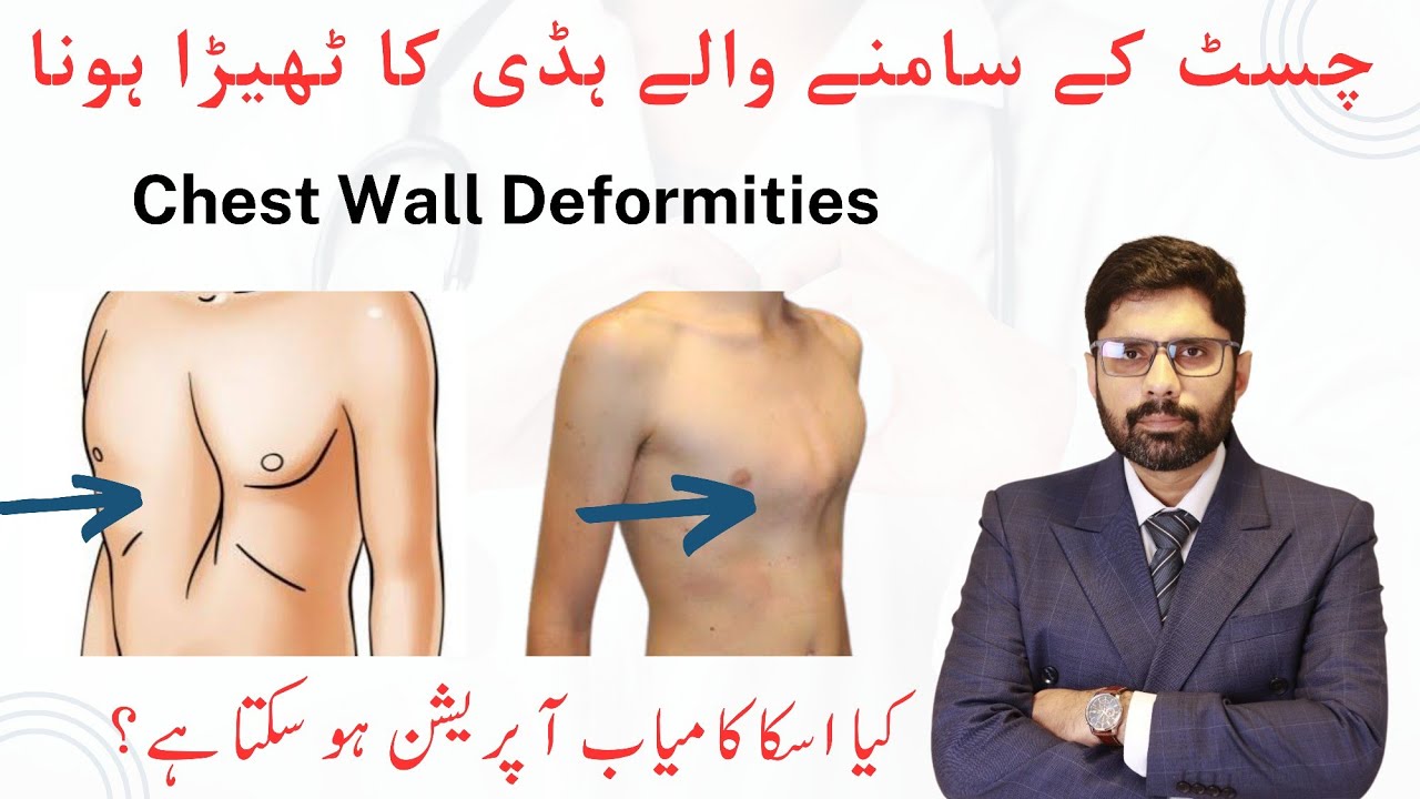 Chest Wall Deformities Pectus Excavatum | Pectus Carinatum | Surgical Treatment by Thoracic Surgeon