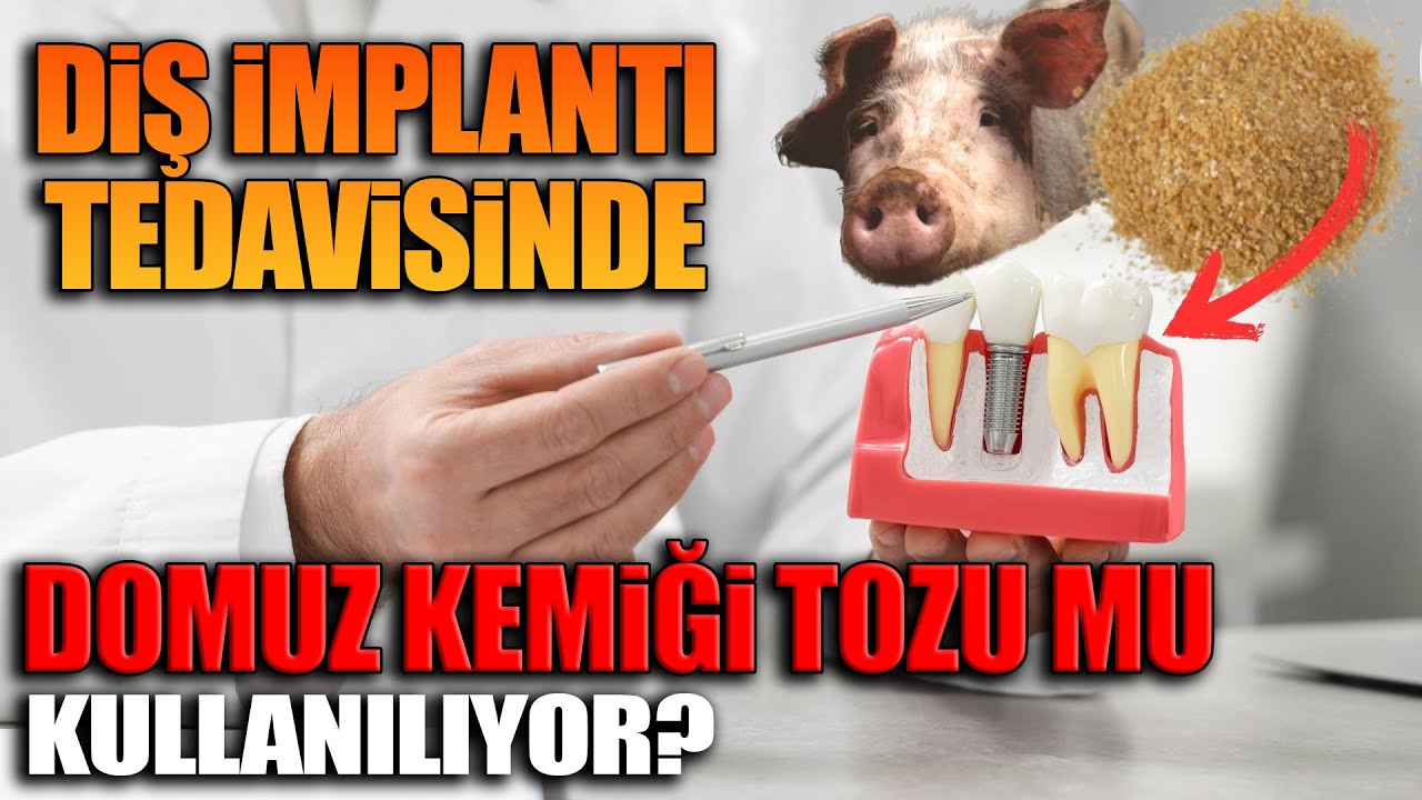 Diş implantı tedavisinde domuz kemiği tozu mu kullanılıyor?