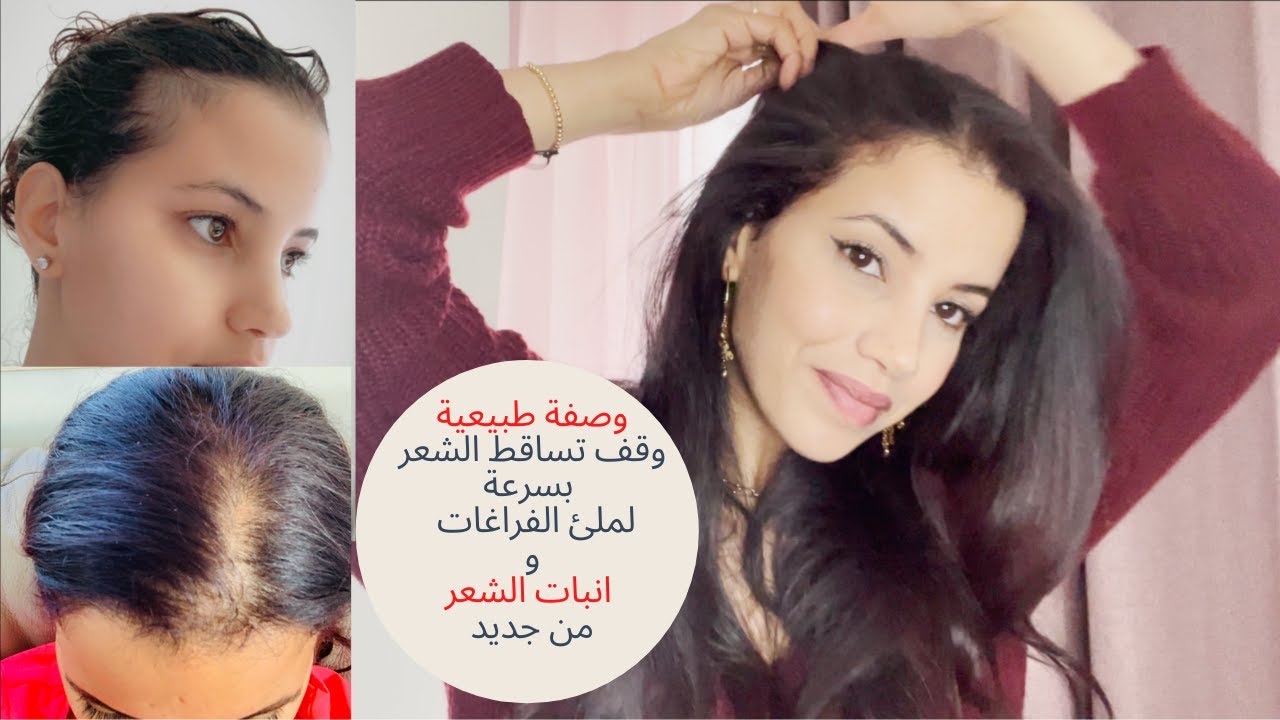 علاج تساقط الشعرالفعال وصفة طبيعية لملئ الفراغات و انبات الشعر من جديد