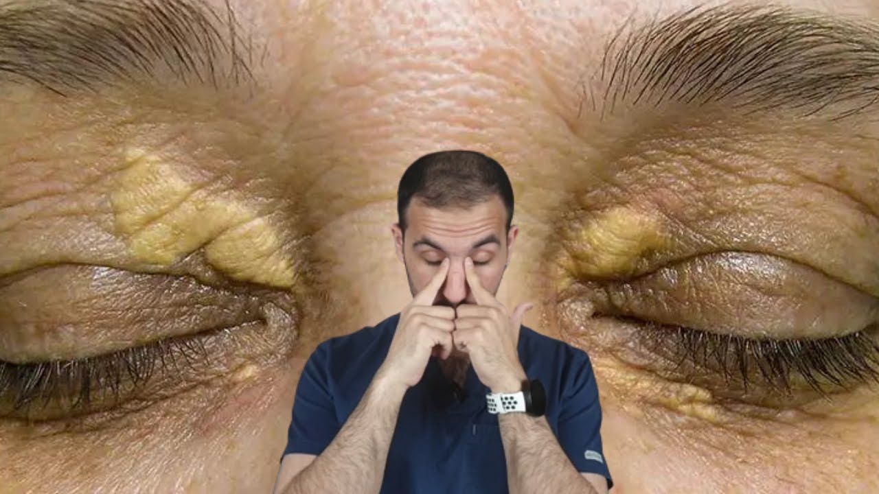 ترسب الدهون حول العين 👀 (اللويحة الصفراء)