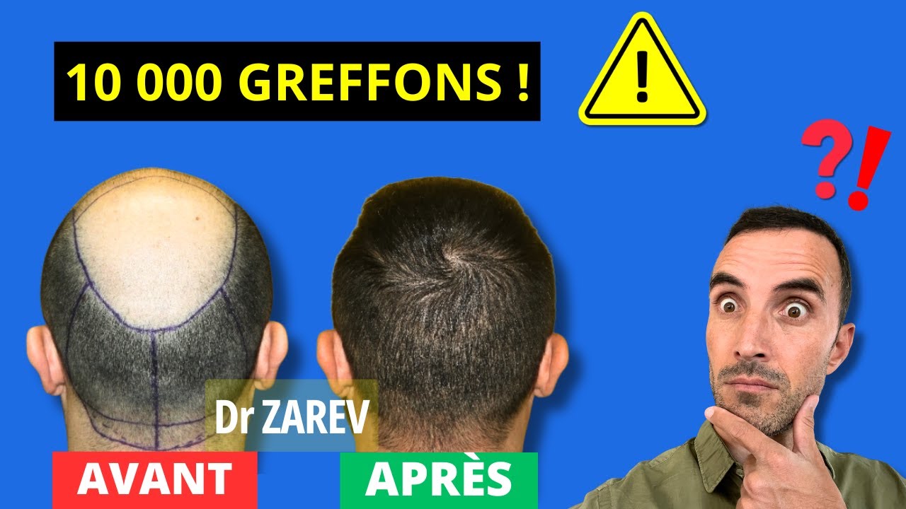 Greffe de cheveux : 10.000 greffons c’est trop 🤯? (Même avec le dr Zarev 🧐?)