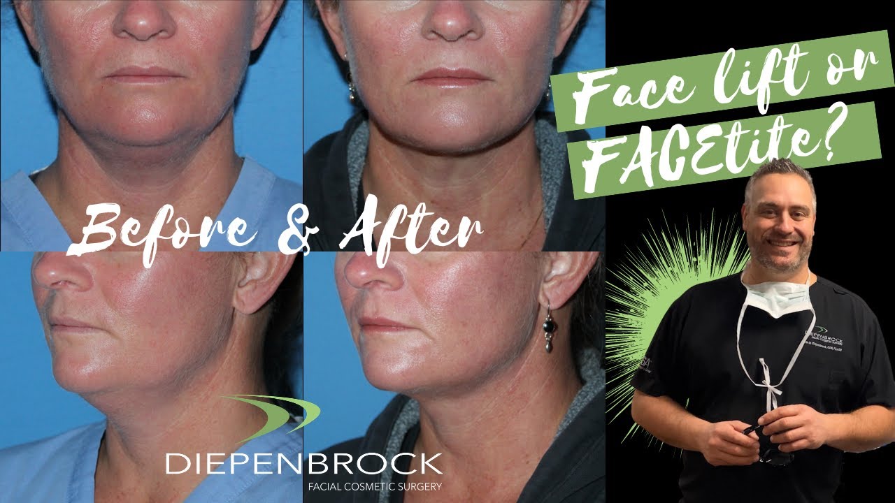 What is FACEtite?  - Minimally-invasive, face tightening procedure with before and afters by Dr. D.