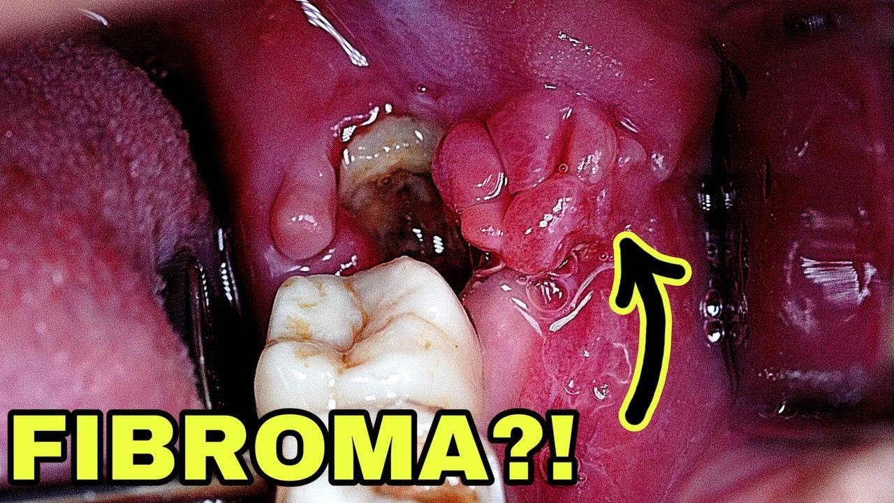 Removing Wisdom Tooth | ODONTECTOMY | Dentist | Dokter Gigi Tri Putra