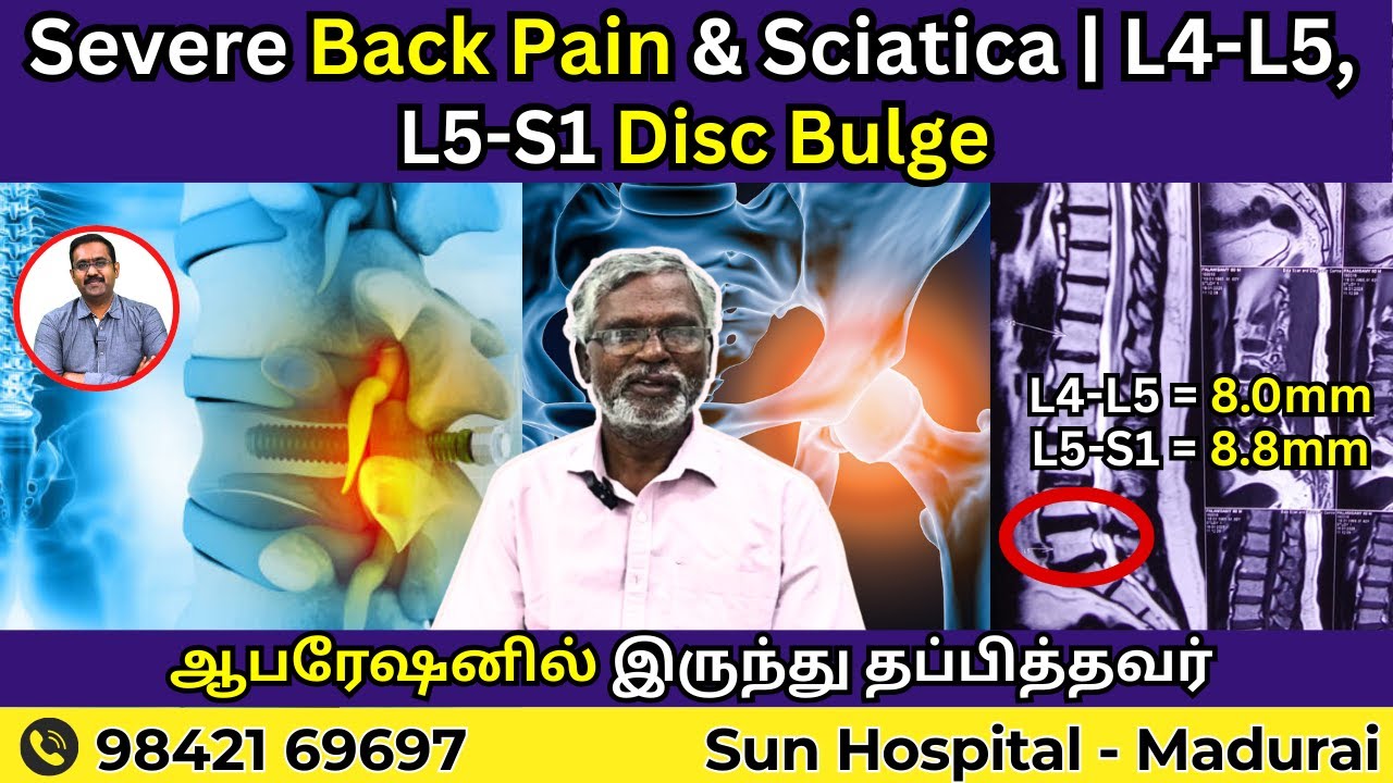 Severe Back Pain & Sciatica | L4-L5, L5-S1 Disc Bulge ஆபரேஷனில் இருந்து தப்பித்தவர் | Sun Physio