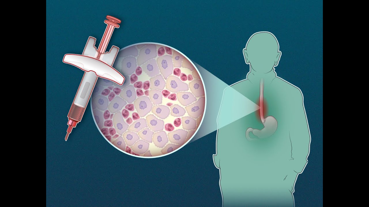 Dupilumab for Eosinophilic Esophagitis | NEJM