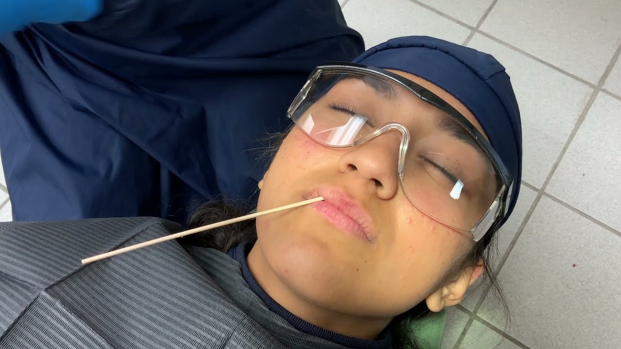 Técnica Nasopalatina a 3 punciones