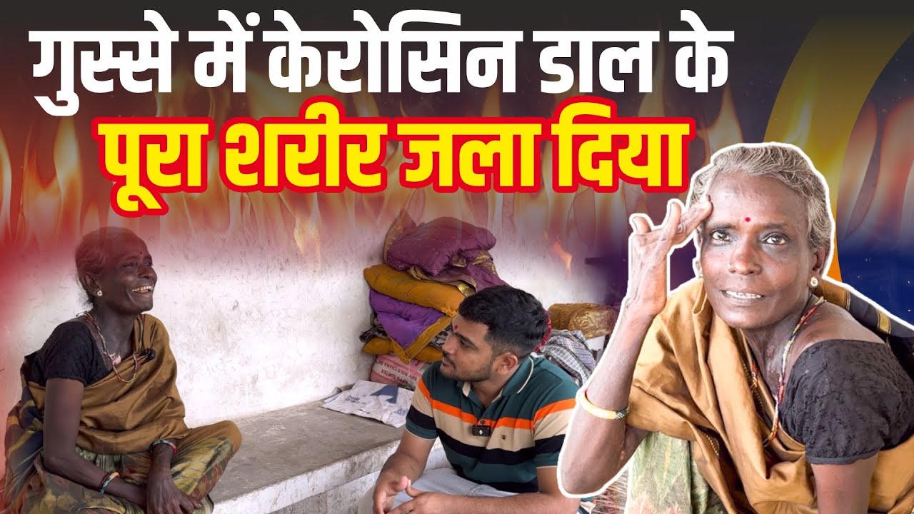 In anger he burnt his whole body with kerosene 😡 || ग़ुस्सा में  शरीर जला दिया || Popatbhai Ahir