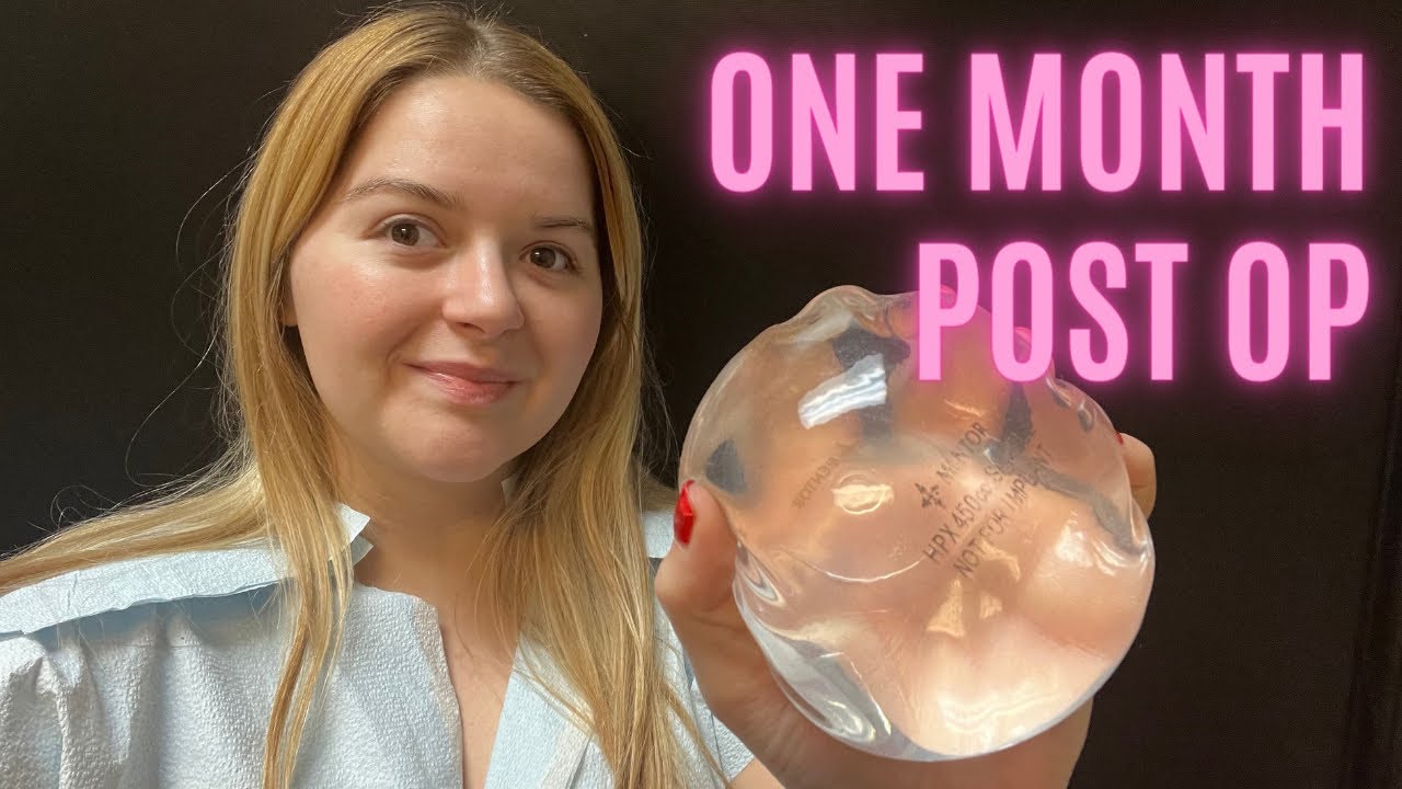 Breast Augmentation 1 Month Post Op Update! Implant Exchange with a Lift Surgery