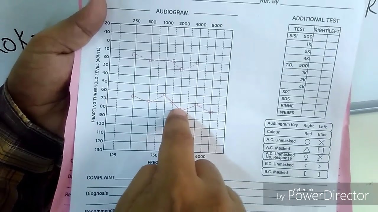 How to interpret a Pure Tone Audiogram (PTA)