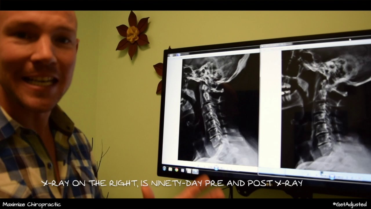 Degenerative Disc Disease - Sacramento Chiropractor