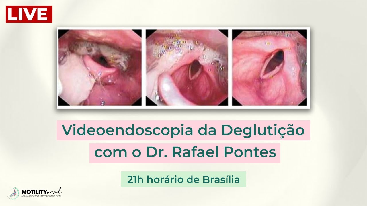 Videoendoscopia da Deglutição com o Dr. Rafael Pontes