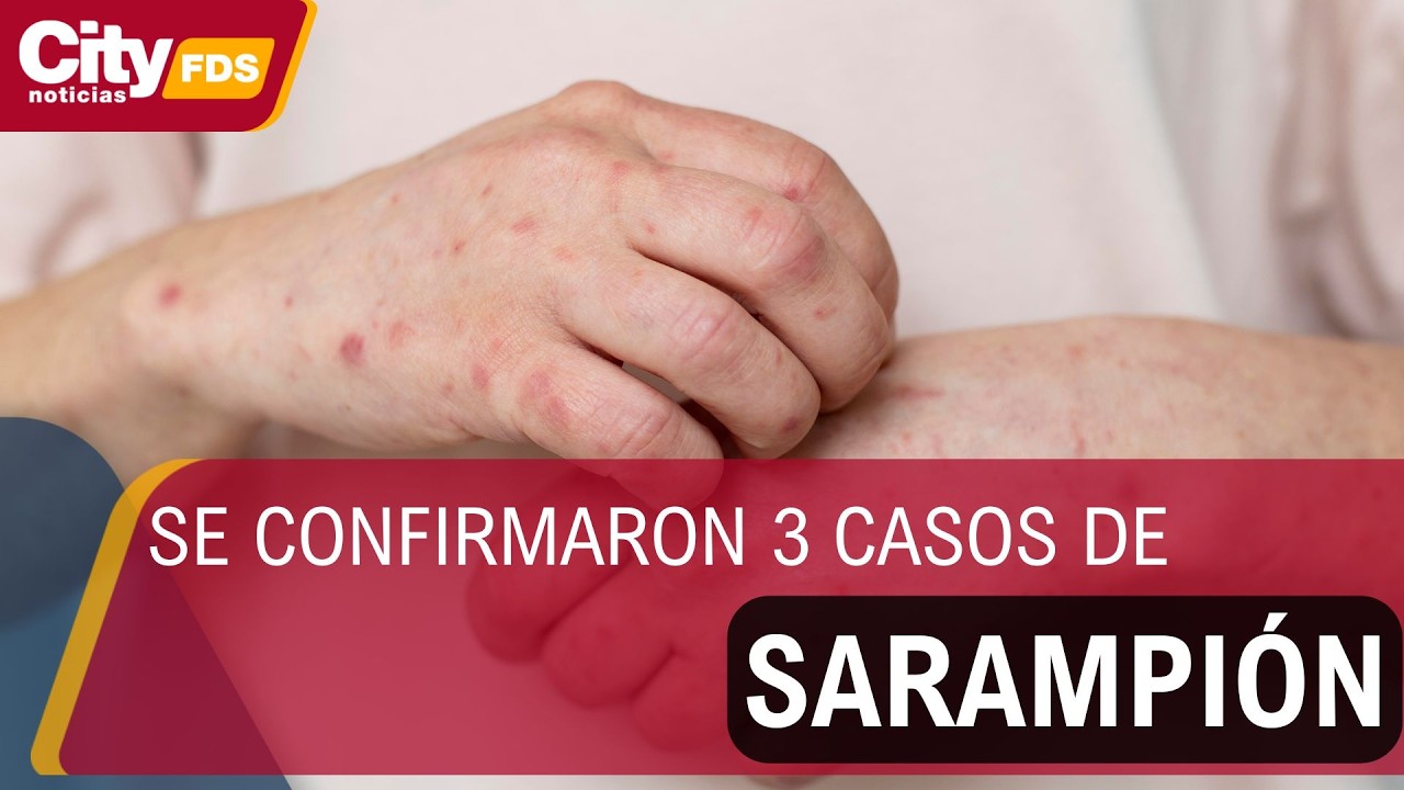 Alerta por sarampión en Bogotá: refuerzan vacunación tras casos importados | CityTv