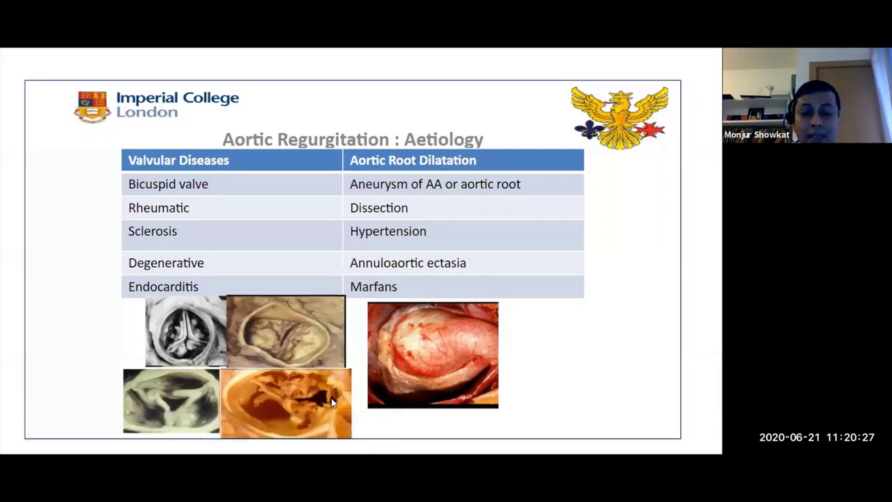 Philips Echo Webinar Series Aortic Regurgitation The Unexplained by Dr  Monjur Showkat, Imperial Col