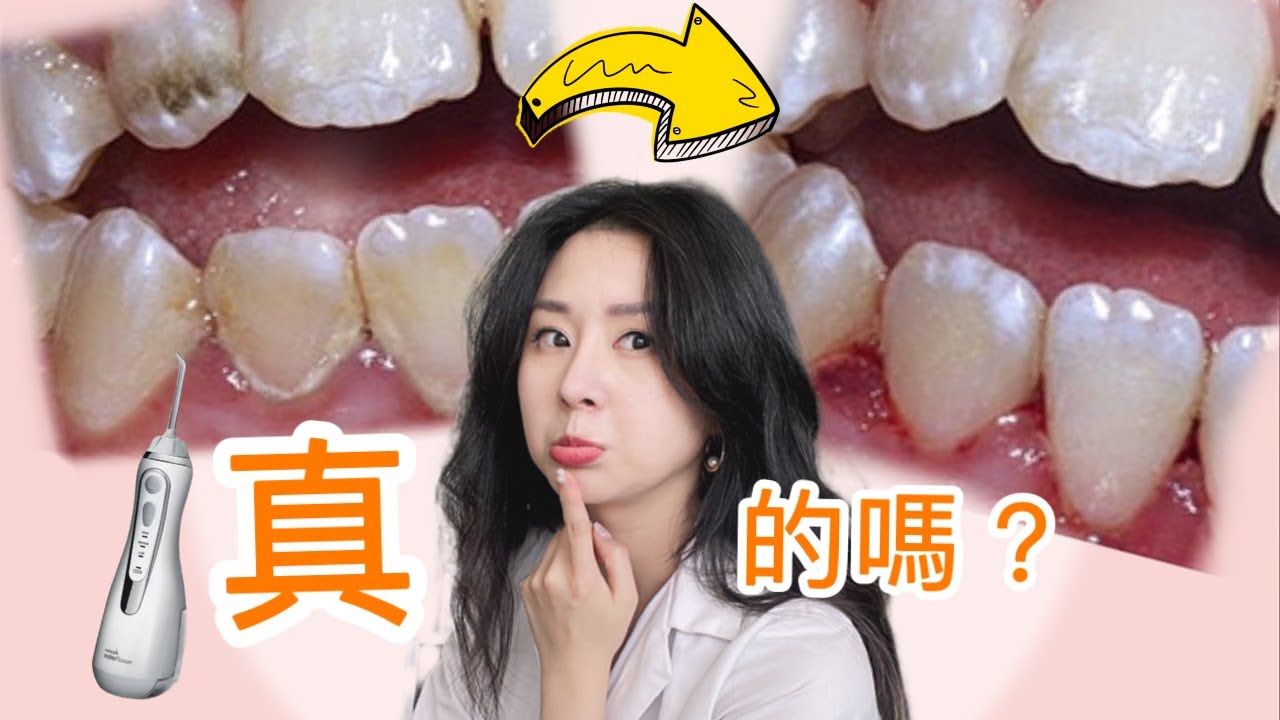 [你誤解 沖牙機了]  真的需要買嗎？牙醫示範如何正確使用！